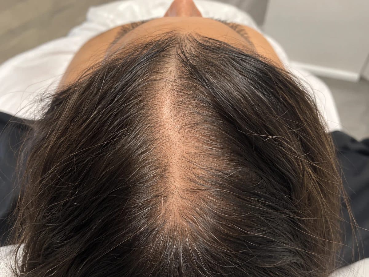 Before Jet Peel Hair Restoration treatment