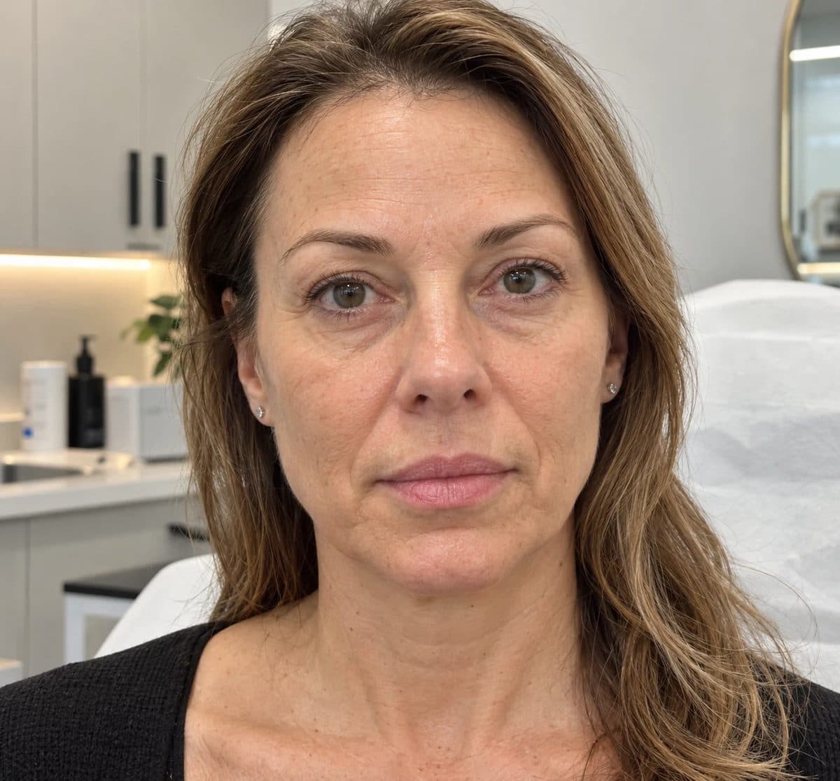 Before Dermal Fillers treatment