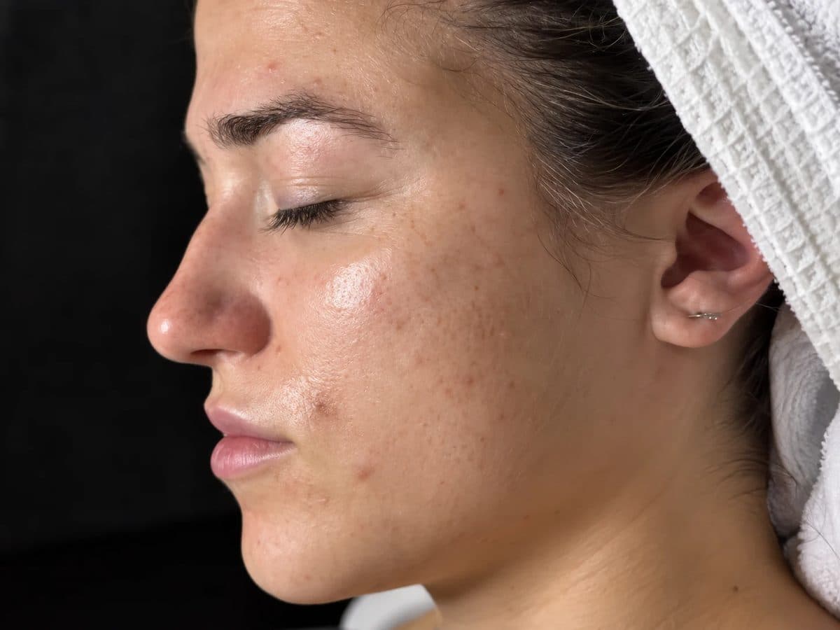 Before Jet Peel Facial treatment