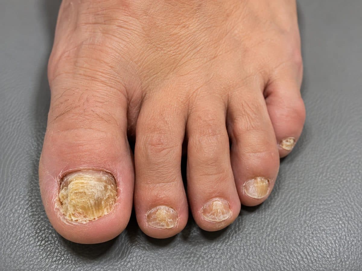 Before Laser Nail Fungus Treatment treatment