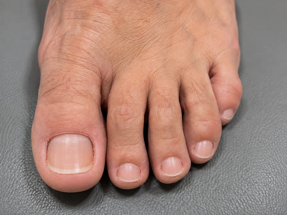 After Laser Nail Fungus Treatment treatment at Allure Medical Aesthetics