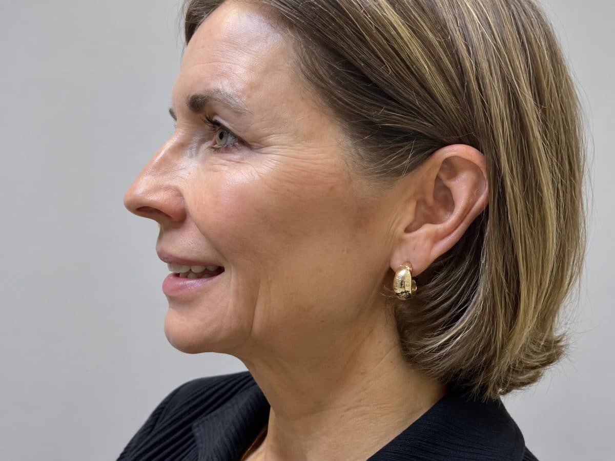 Before Radiesse Injectable Filler treatment