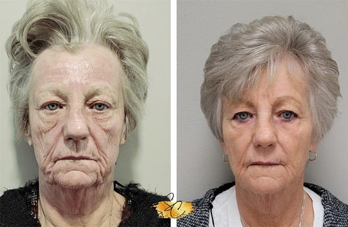 NeoGen PSR treatment at Allure Medical Aesthetics