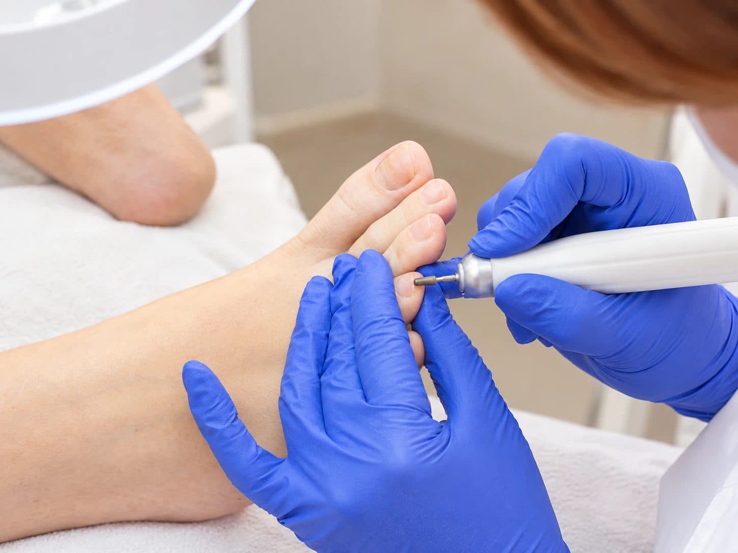 Laser Nail Fungus Removal